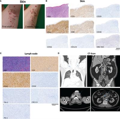 Deconvolution of Adult T-Cell Leukemia/Lymphoma With Single-Cell RNA-Seq Using Frozen Archived Skin Tissue Reveals New Subset of Cancer-Associated Fibroblast